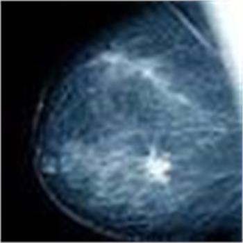 ماموگرافی به موقع می تواند تا 25 درصد مرگ و میر ناشی از سرطان سینه را کاهش دهد