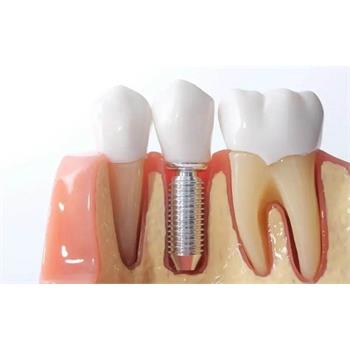 ایمپلنت یا کاشت دندان برای چه افرادی مناسب است؟