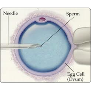 انجام اولین عمل میکرواینجکشن( تزریق درون سیتوپلاسمی اسپرم) در مرکز آموزشی درمانی و تحقیقاتی معتضدی