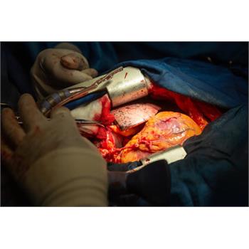 گزارش تصویری جراحی قلب‌باز در بیمارستان امام‌علی (ع)