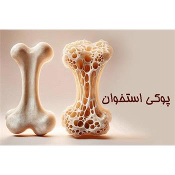 راههای مقابله با «پوکی استخوان» در هفته ملی سلامت استخوان