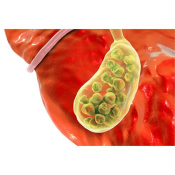 "سنگ صفرا" چگونه درمان می‌شود؟
