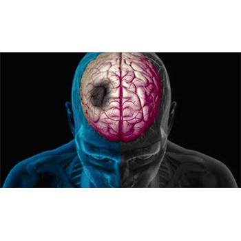 نجات جان ۳۴ بیمار سکته مغزی در کرمانشاه