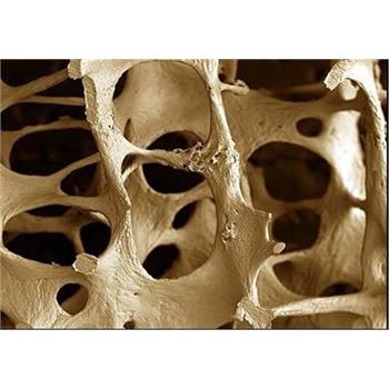 پوکی استخوان باتشخیص به موقع مهار می شود