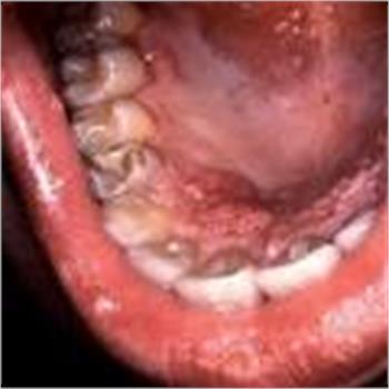 میزان ابتلا به سرطان دهان در میان ساکنان غرب کشور بالاست.