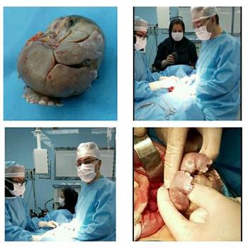 جراحى بسیار نادر  بر روی نوزاد در بیمارستان دکتر محمد کرمانشاهى