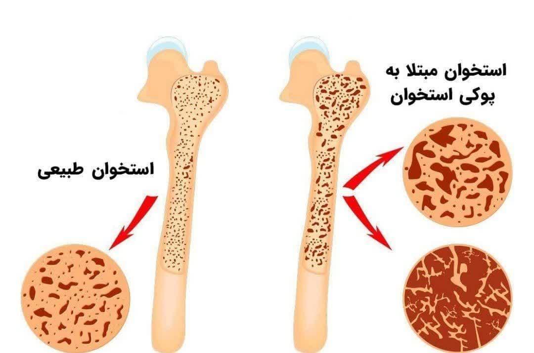 پوکی استخوان
